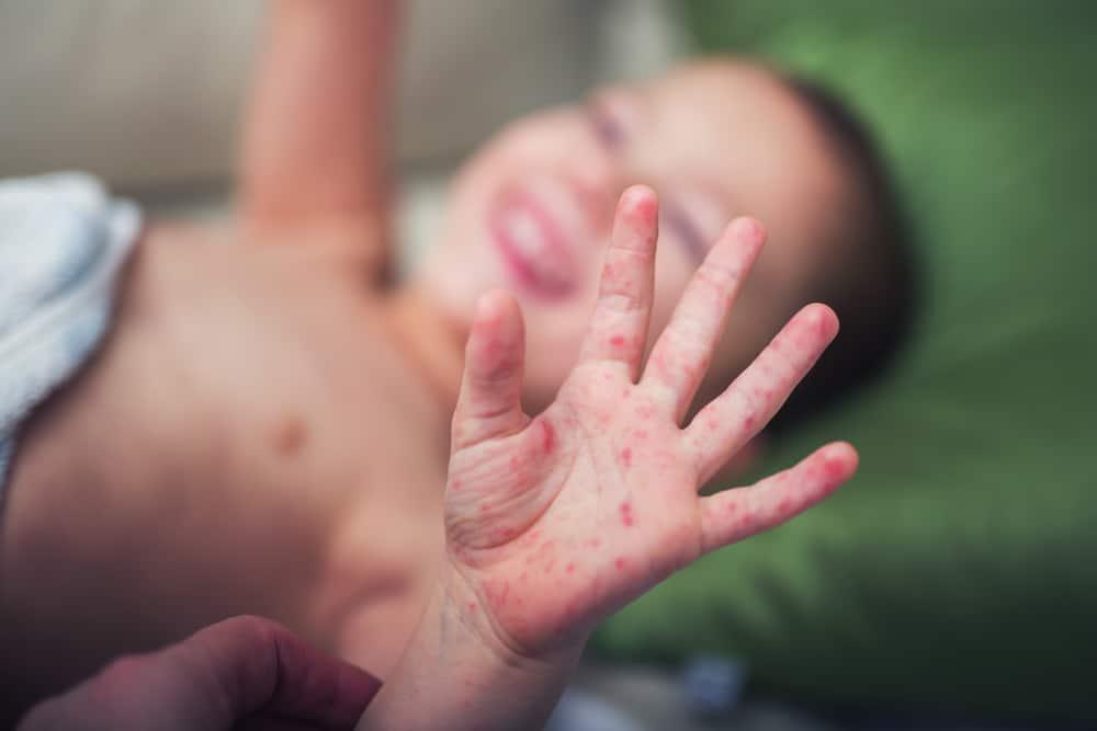 Bagaimana Menangani Penyakit Tangan Kaki dan Mulut (HFMD) pada Anak Anda