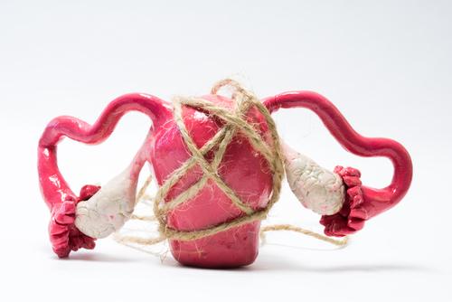'Secondary Dysmenorrhea' Bukan Senggugut Biasa