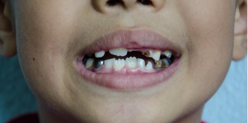 mencegah-kerosakan-gigi-kanak-kanak