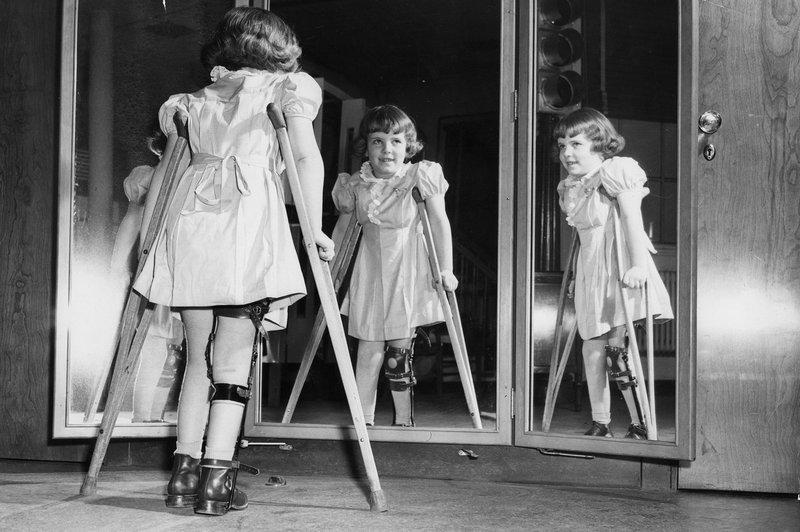 Polio: Penyakit Bersejarah