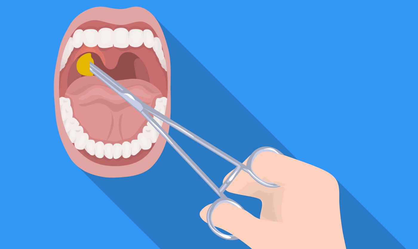 Tonsilektomi: Keperluan Pembedahan Membuang Tonsil