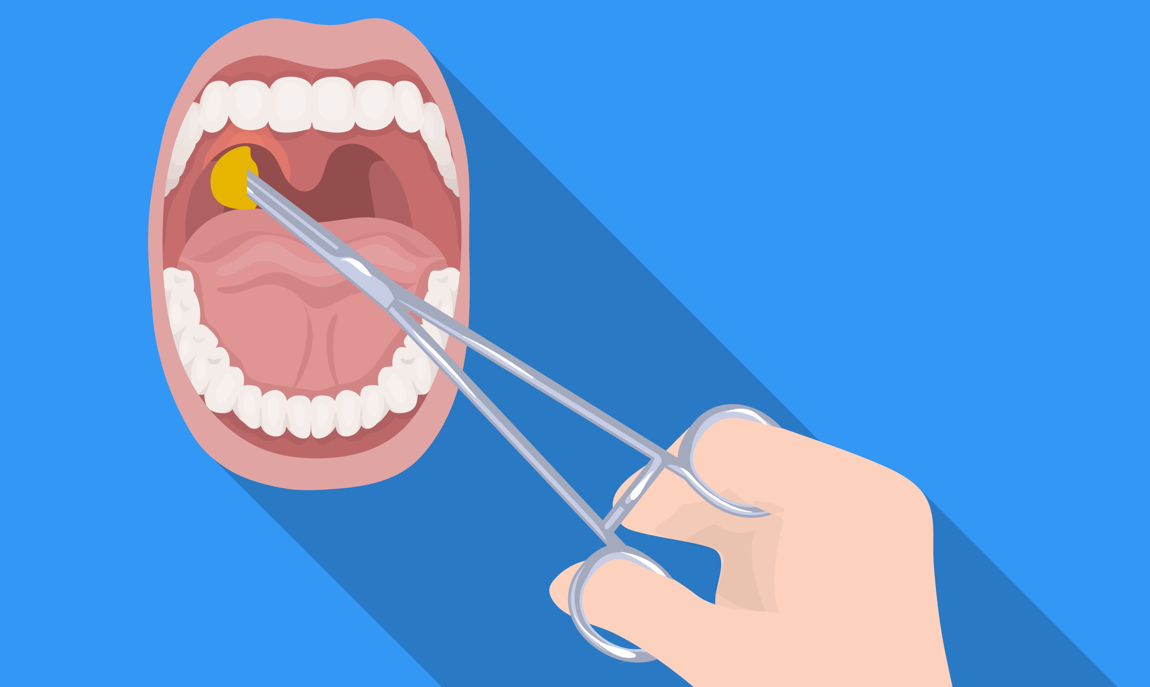 Tonsilektomi: Keperluan Pembedahan Membuang Tonsil