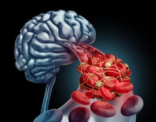 Cerebrovascular Accident Adalah Strok
