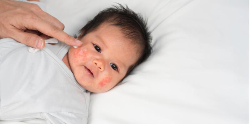 Sedih Lihat Kulit Bayi Alami Ekzema Yang Kronik, Kenali Lebih Mendalam Apakah Puncanya!