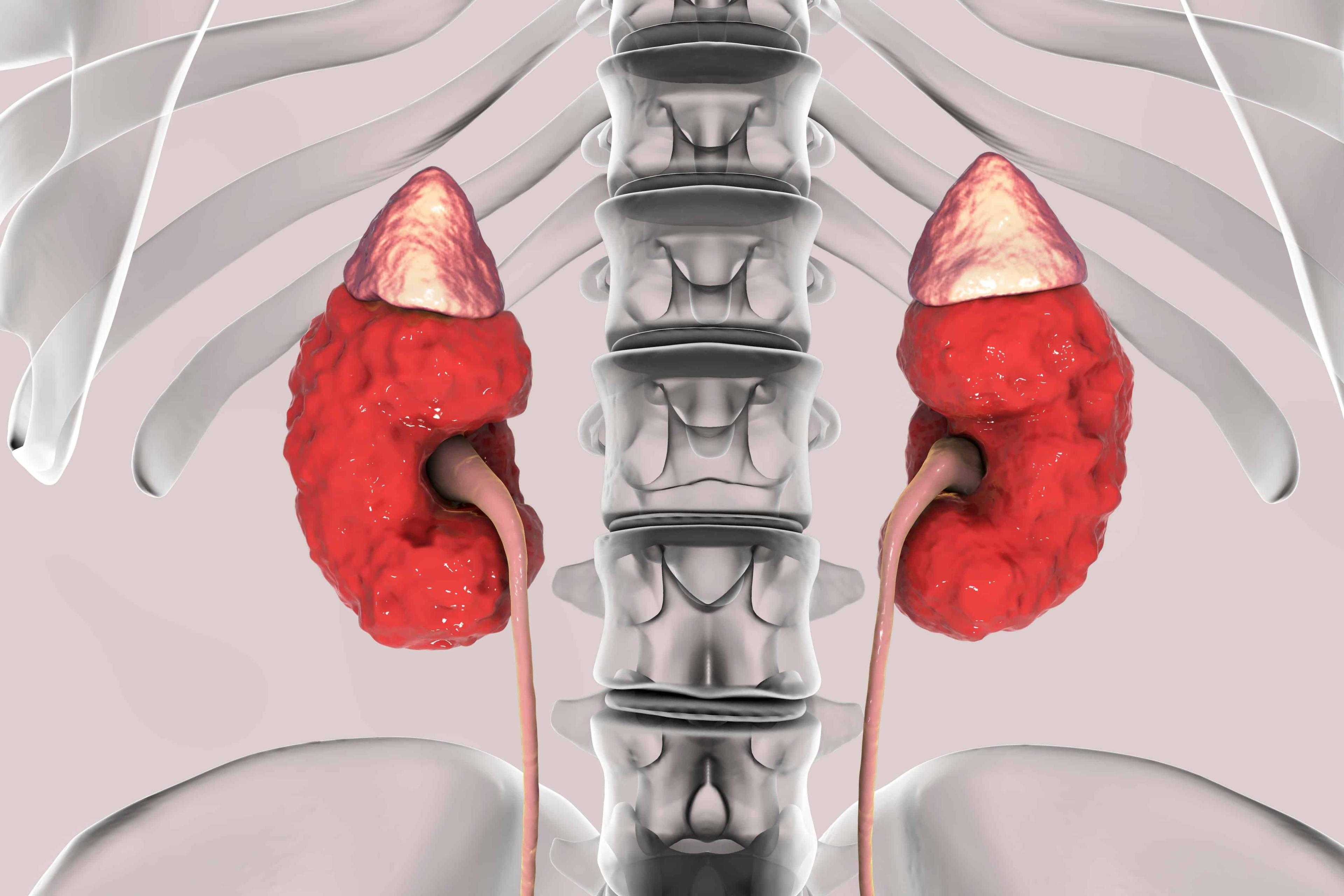 penyakit-buah-pinggang-kronik