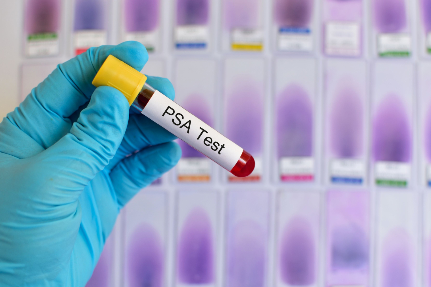 PSA Test: Adakah ia Penting?