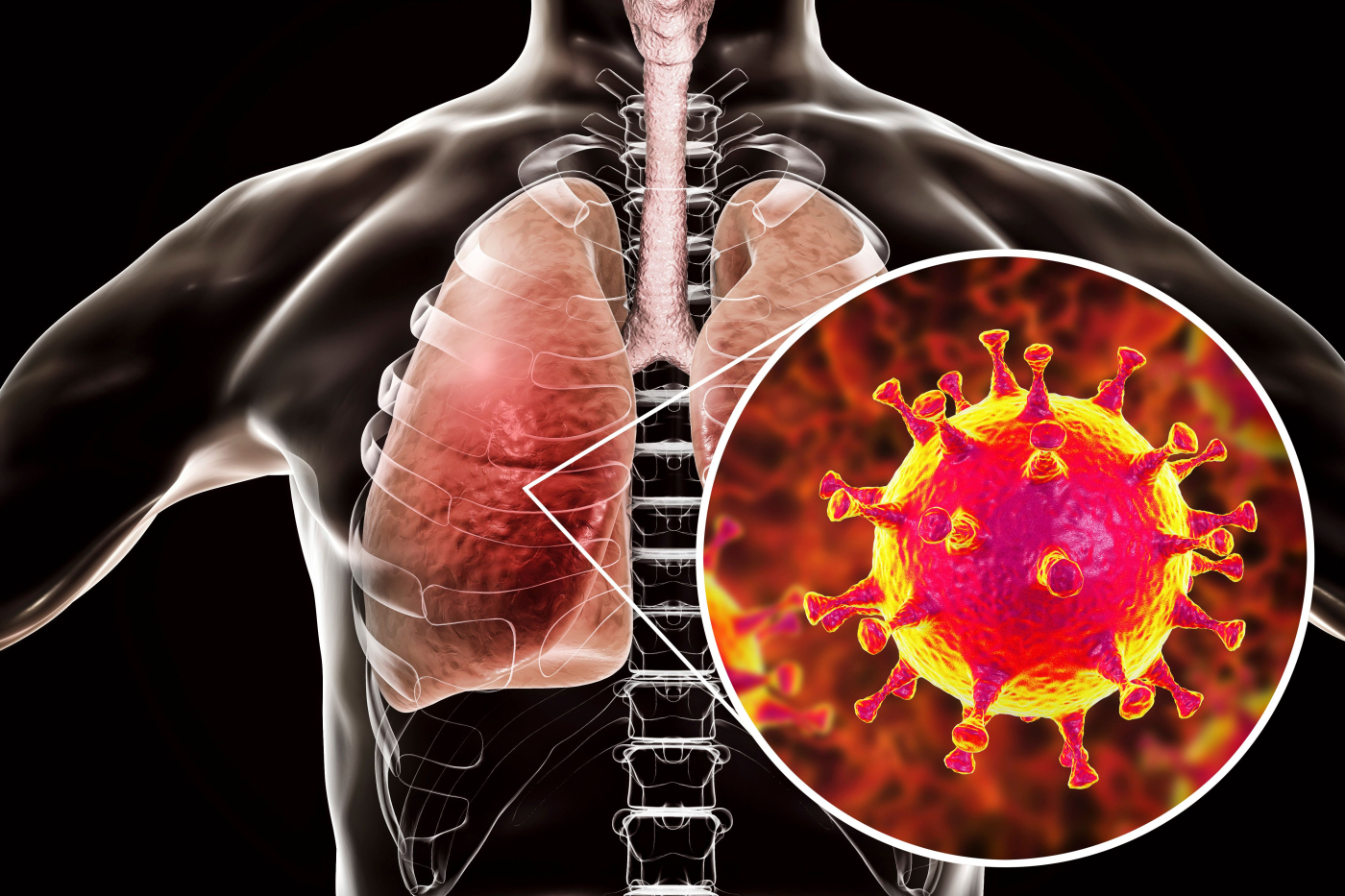 MERS-CoV: Pencegahan dan Rawatan