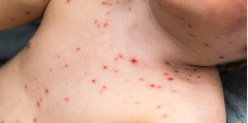 Tumbuh Bintik Merah Di Badan, Ini Cacar Air Atau Campak? Begini Perbezaannya!