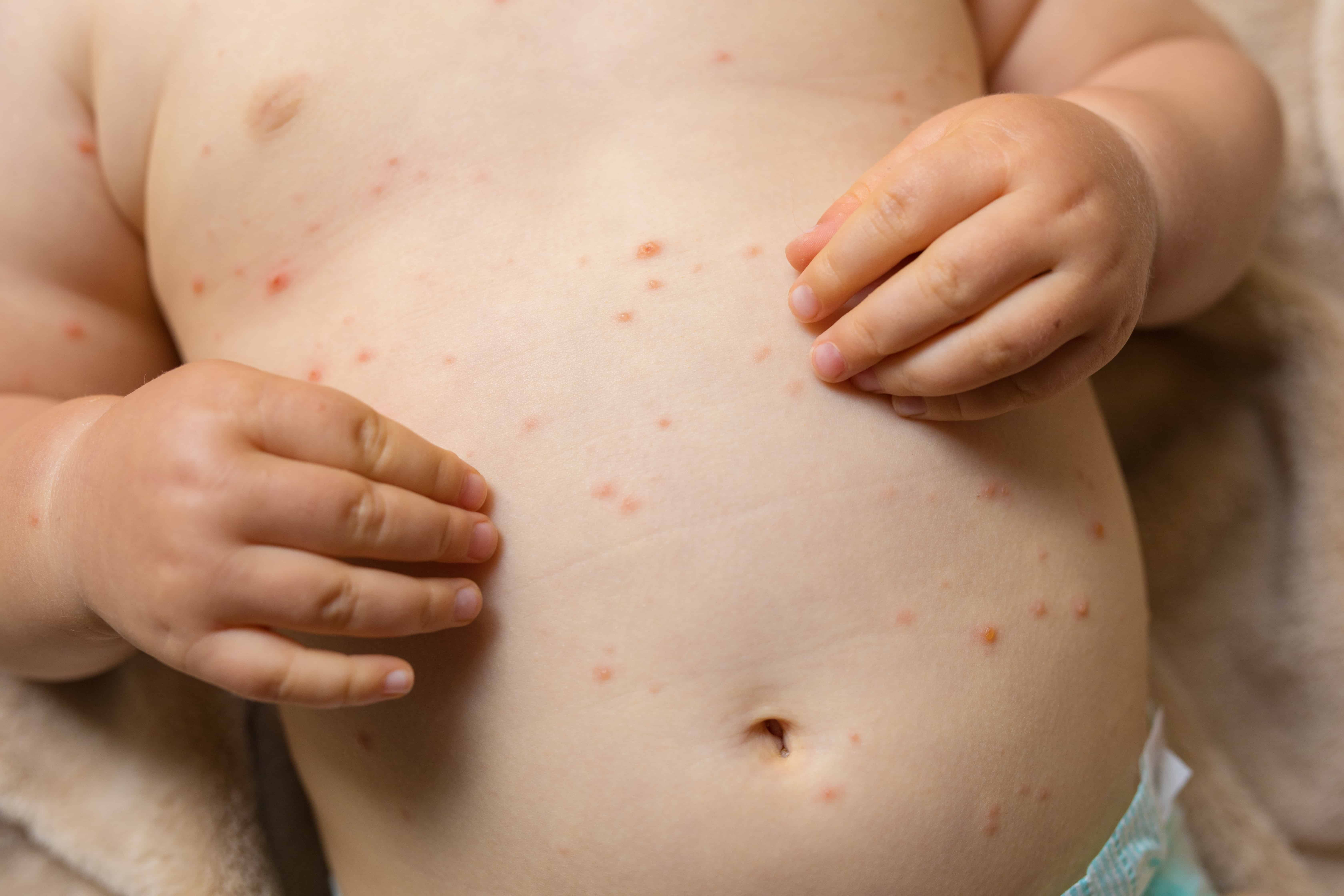 Chickenpox: Penyakit Berjangkit Bawaan Virus