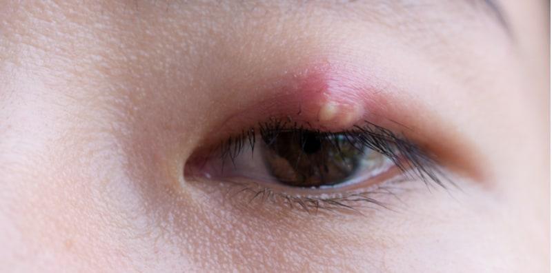 Mata Bengkak Sebab Ketumbit? Ini Cara Merawatnya Di Rumah!