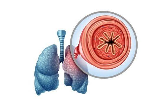 Kekeliruan COPD dan Asma, Mungkin Sama Tapi Sangat Berbeza