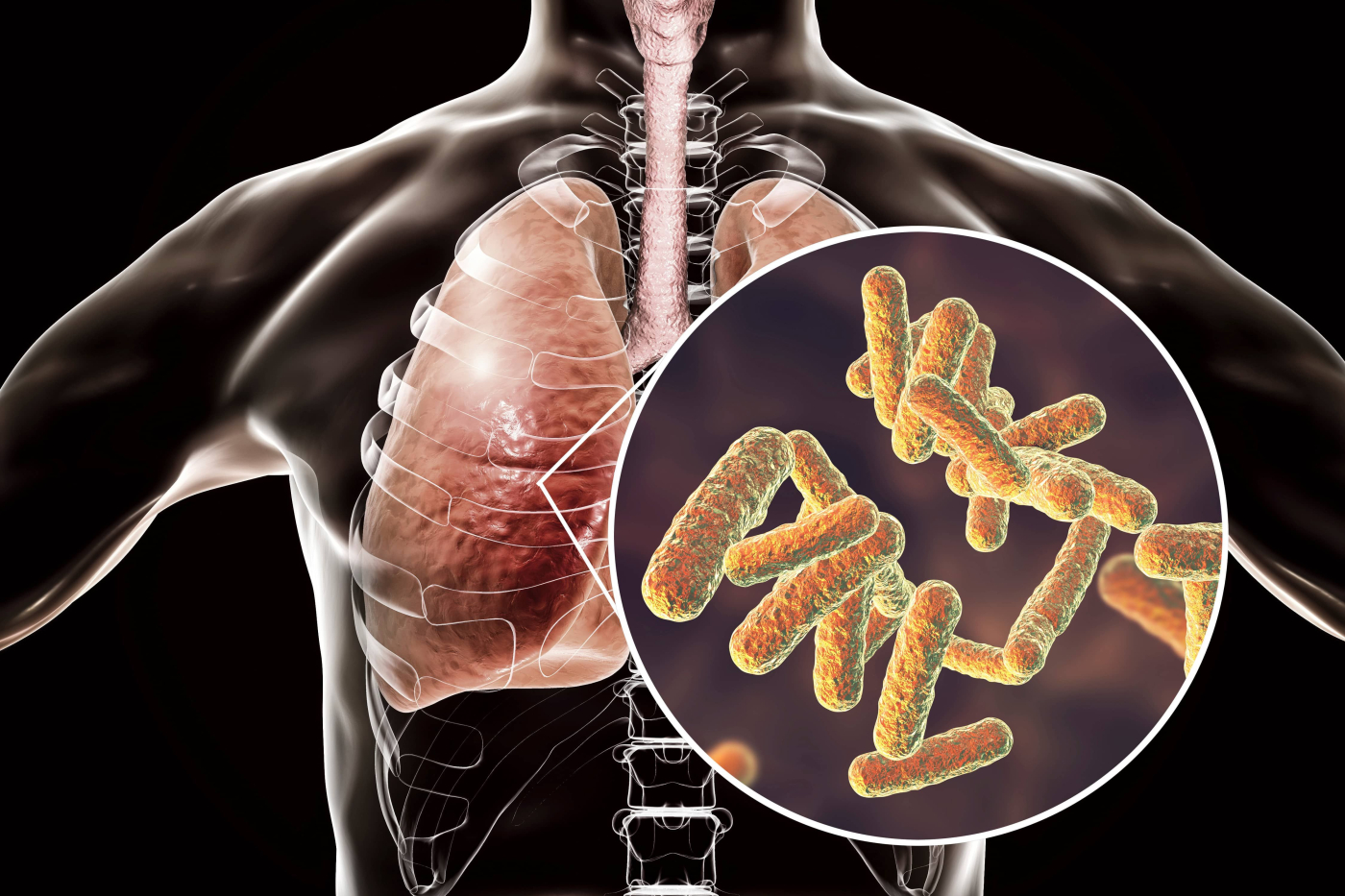 Pneumonia: Dari Luar atau Dalam Hospital