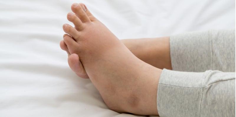 atasi-masalah-kaki-bengkak-semasa-hamil