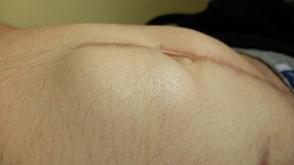 Angin Pasang: Benjolan Pada Abdomen