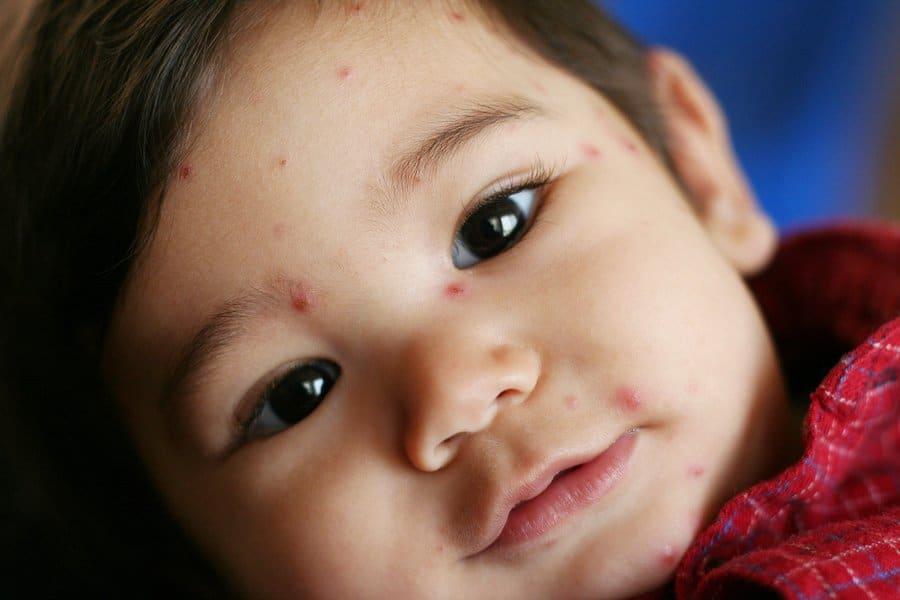 “Chicken Pox”: Cacar Air terhadap Kanak-kanak