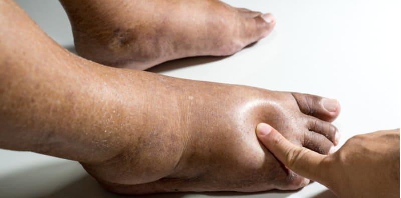 6 Masalah Ini Boleh Jadi PUNCA Anda Alami KAKI BENGKAK, Semak Sekarang!