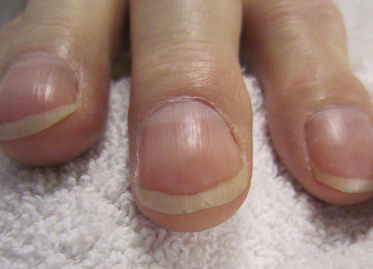 Finger Clubbing: Perubahan Bentuk Jari dan Kuku