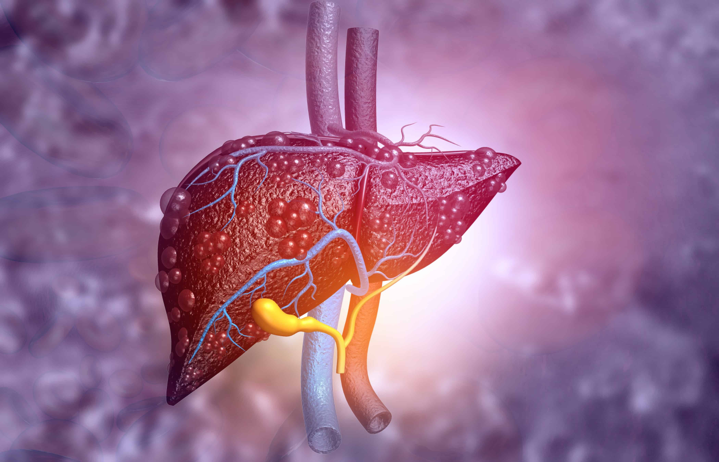 Budd-Chiari Syndrome: Pembuluh Darah Vena Hati Tersumbat