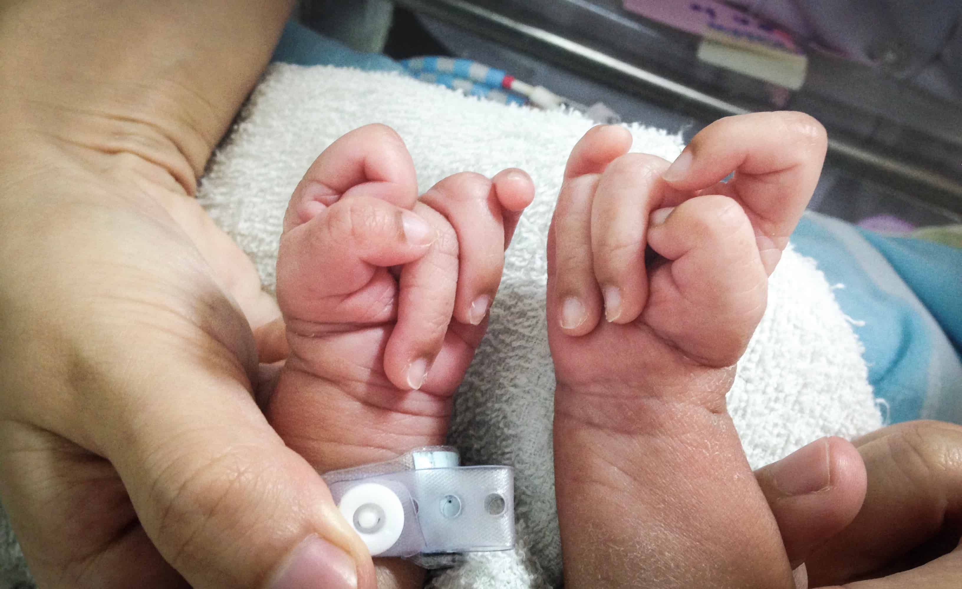 sindrom-edward-hanya-50-bayi-dilahirkan-hidup