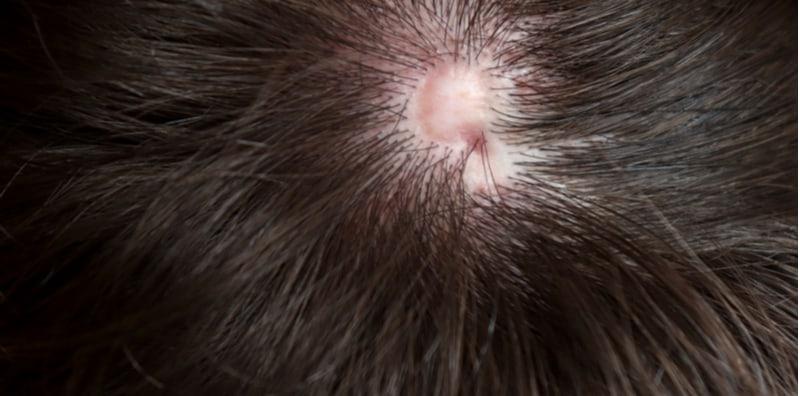 Sejak Lahir Terdapat Ketiadaan Kulit Di Bahagian Tertentu, Kenali Apa itu Aplasia Cutis Congenita