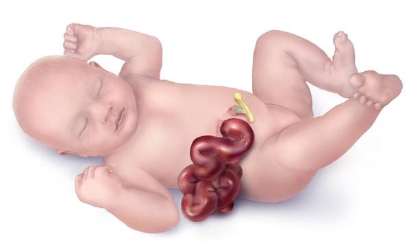 Gastroschisis: Usus Di Luar Tubuh Bayi