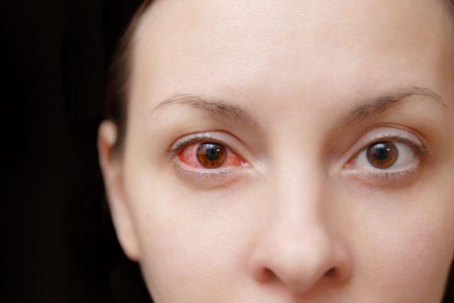 Bahayakah Jangkitan Konjunktivitis?