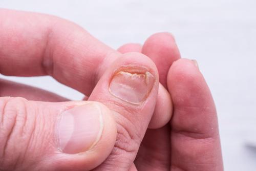 Penyakit Fong: Perkembangan Kuku Terbantut