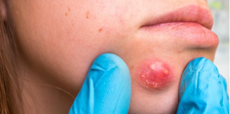 jerawat-atau-bisul-apakah-perbezaannya