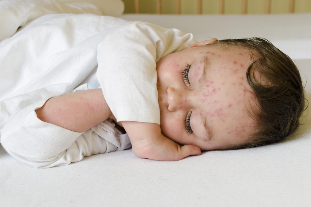 My Baby Has Chickenpox, How Do I Manage the Itchiness?