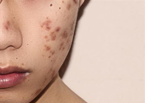 How to Remove Deep Acne Scar Marks from Your Face
