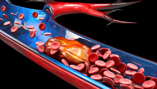 Embolisme Pulmonari: Penyumbatan Saluran Darah di Paru-paru