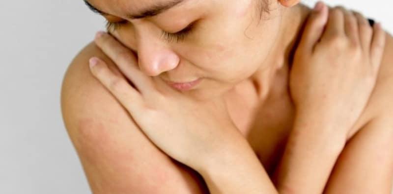 geligata-akibat-alergi-air