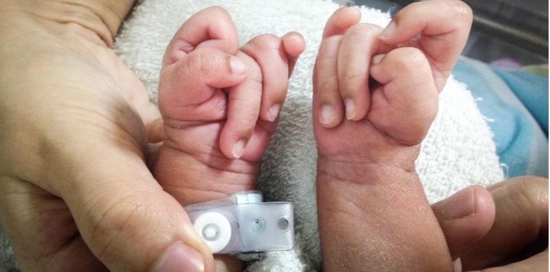 Kenali Sindrom Patau Pada Bayi, 1 Dari 5 Ribu Bayi Disahkan Menghidapnya!