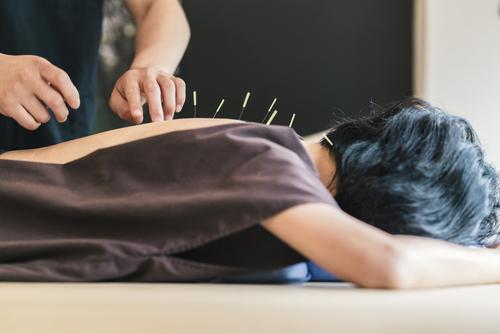 Acupuncture May Reduce Muscle Cramps