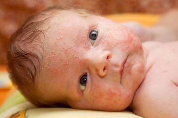 Bayi Tumbuh Jerawat: Apa yang Ibu Bapa Perlu Tahu