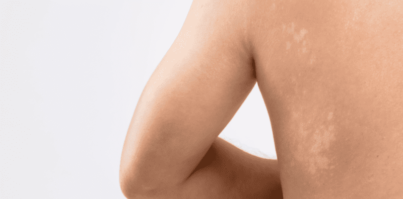 Lepas Berpeluh Terus Mandi Punca Panau Naik Di Badan? Cuba 6 Petua Ini Untuk Hilangkannya!