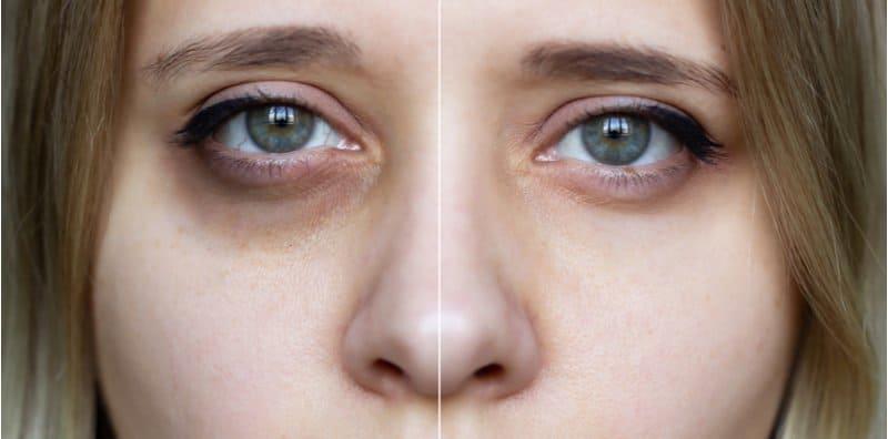 lingkaran-gelap-bawah-mata-apakah-puncanya