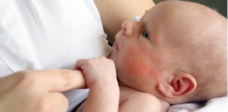 kaitan-gula-dan-ekzema-bayi