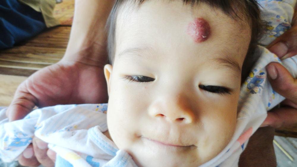 Tanda Lahir Port Wine Stain, Bolehkah Ia Hilang Ataupun Tidak? Ini Jawapannya!
