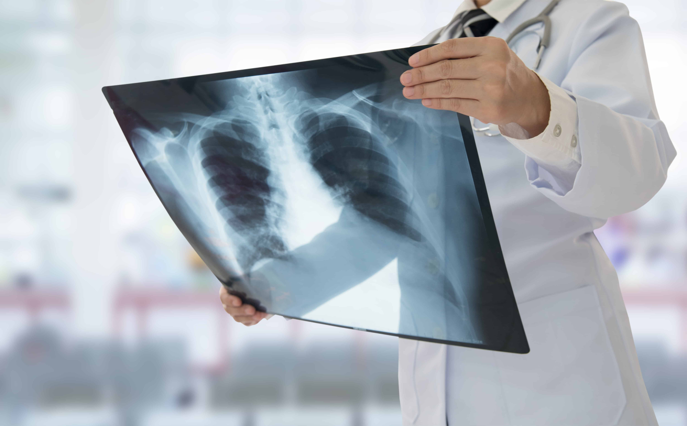 WHO Keluarkan Garis Panduan Baharu Untuk Menangani Tuberkulosis Rintang Ubat