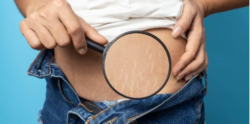 Malu Lihat Selulit Sekitar Kulit Badan, Ini 6 Cara Yang Boleh Mengurangkannya