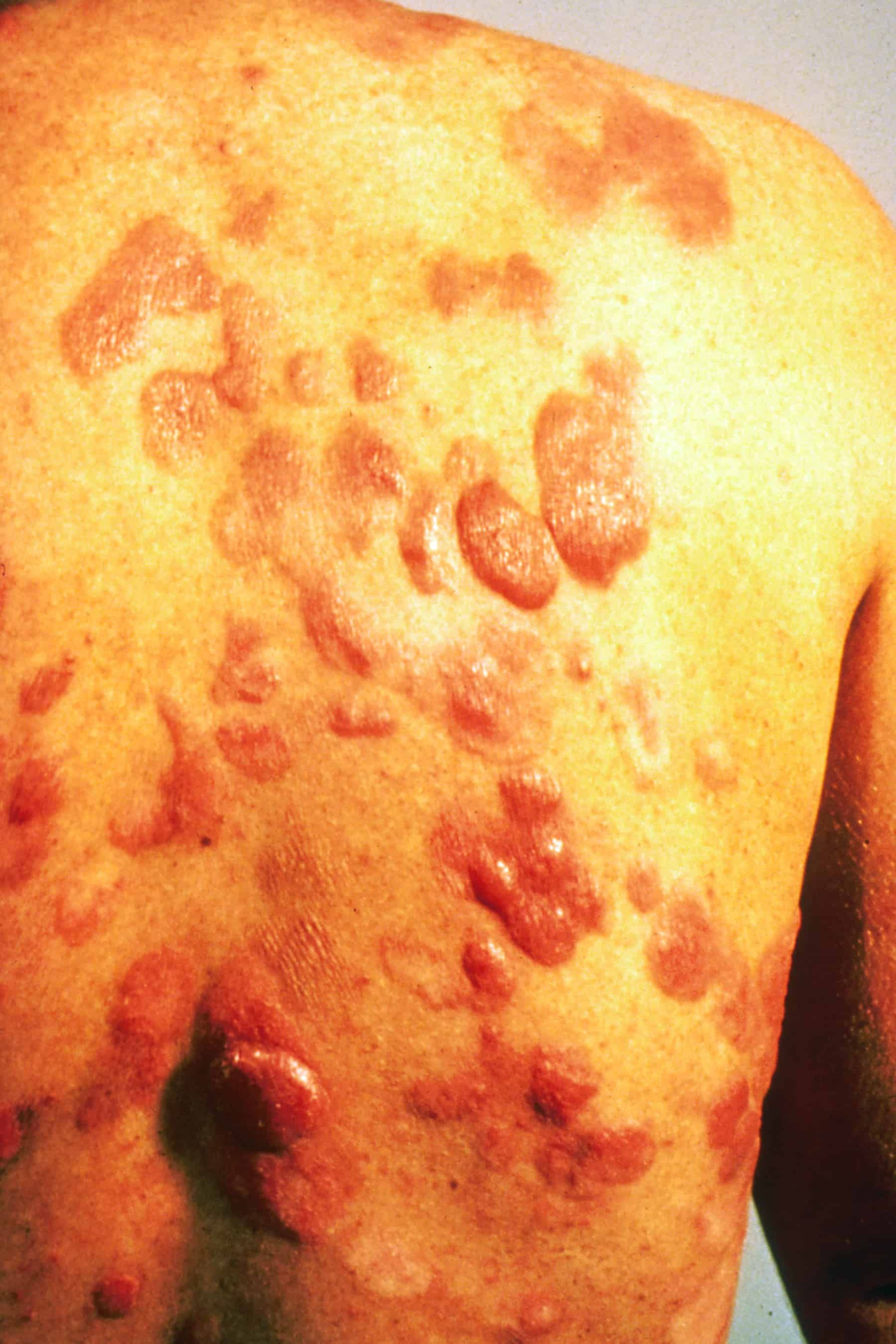 Kaposi's Sarcoma: Kenali Jenis-Jenisnya
