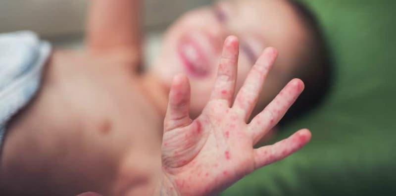 penyakit-kulit-kanak-kanak