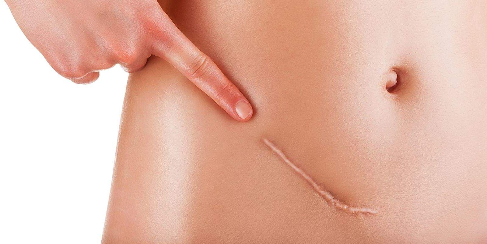 Bagaimanakah Mengurangkan Kesan Parut C-Section?