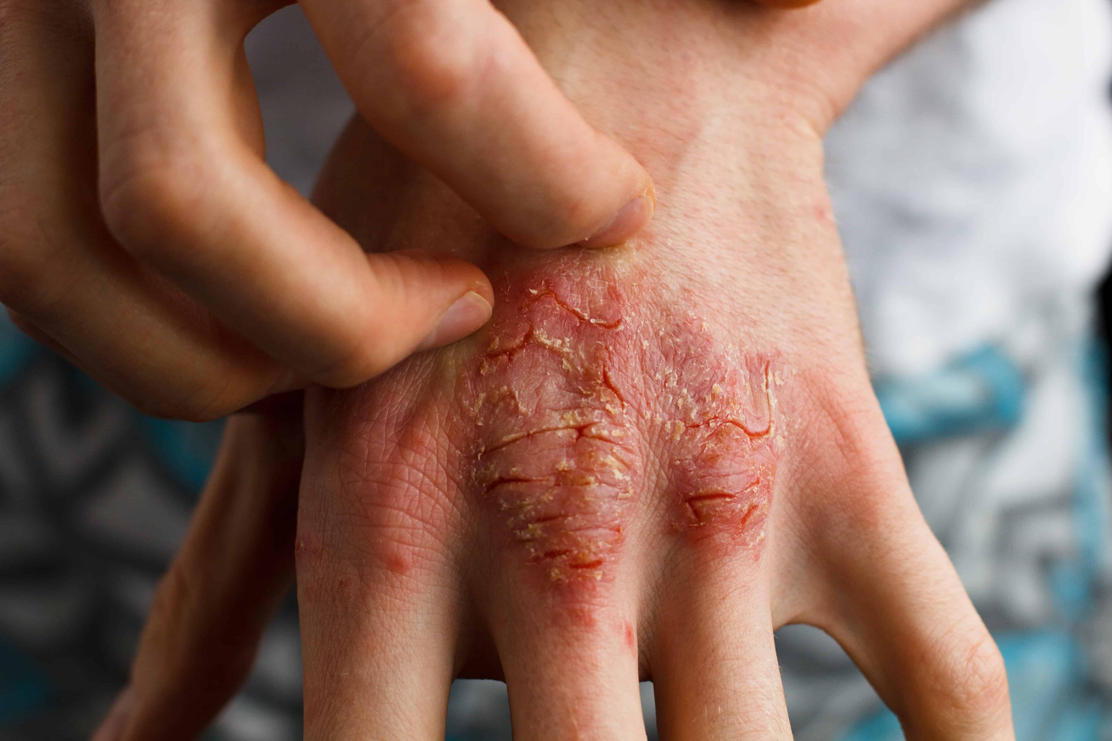 update-on-current-management-of-psoriasis
