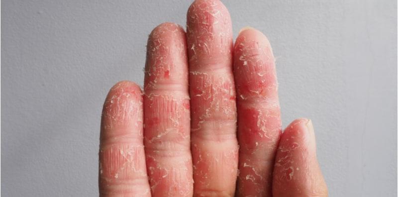 pencetus-umum-ekzema