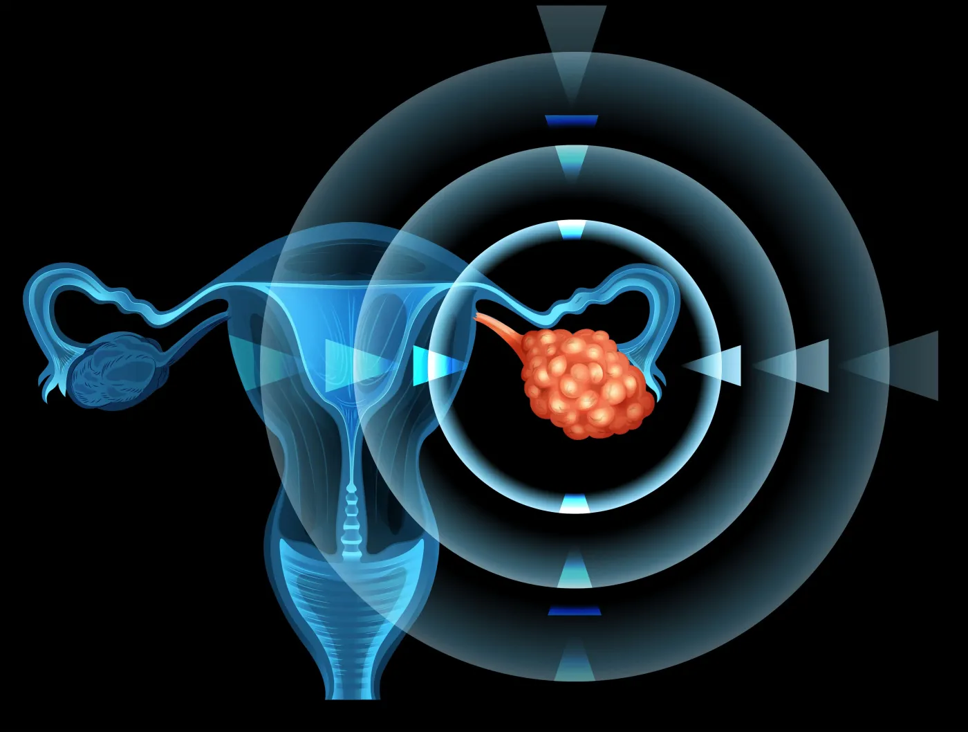 Kanser Ovari: Pengaruh Protein Ran terhadap Metastasis Sel