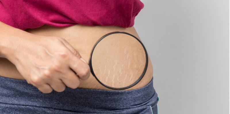 Sakit Hati Tengok Selulit Dekat Badan Sendiri? Ada 11 Cara Hilangkannya Seperti Ini!