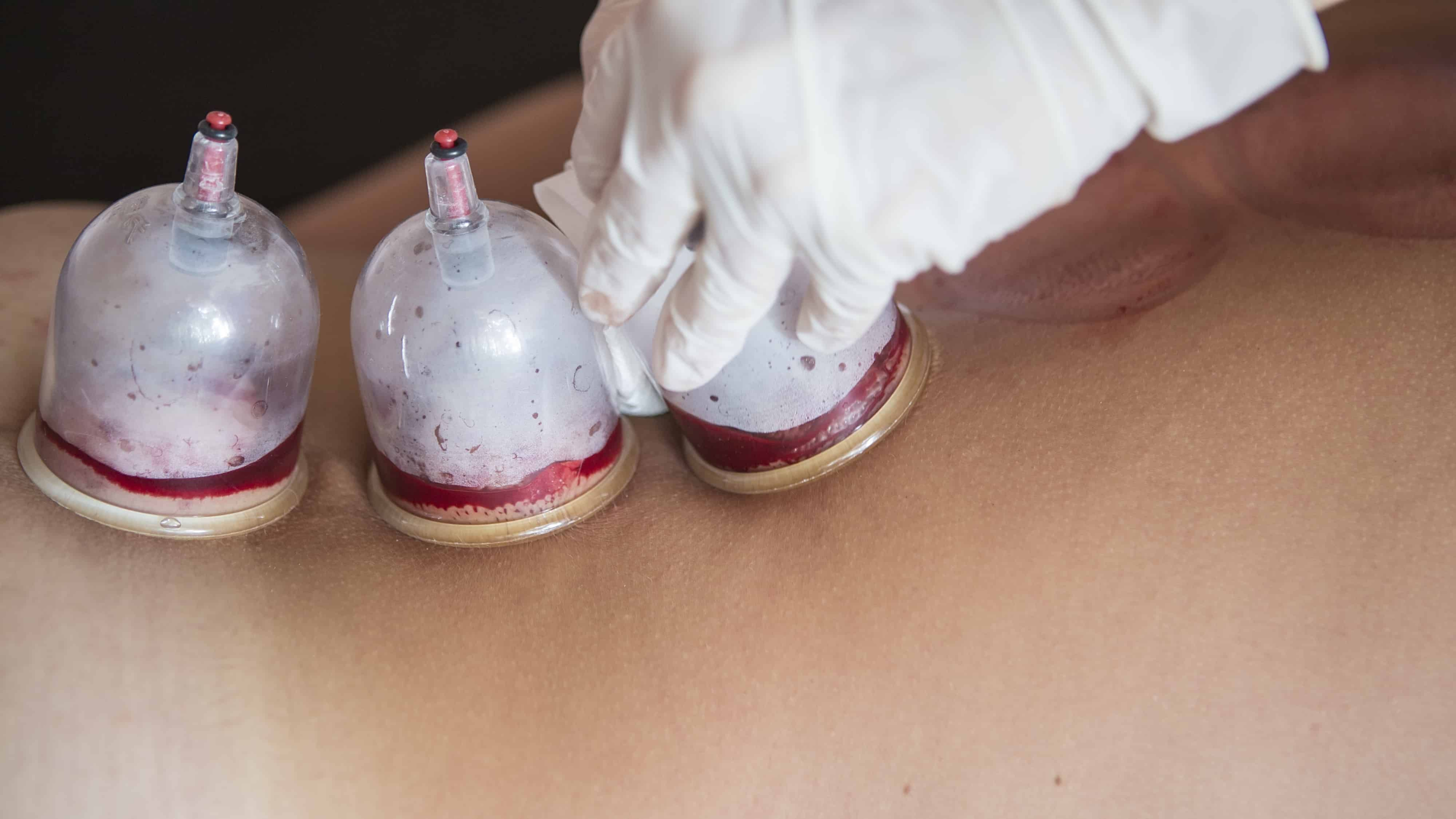 Bekam: Alternatif Rawatan yang Berkesan?