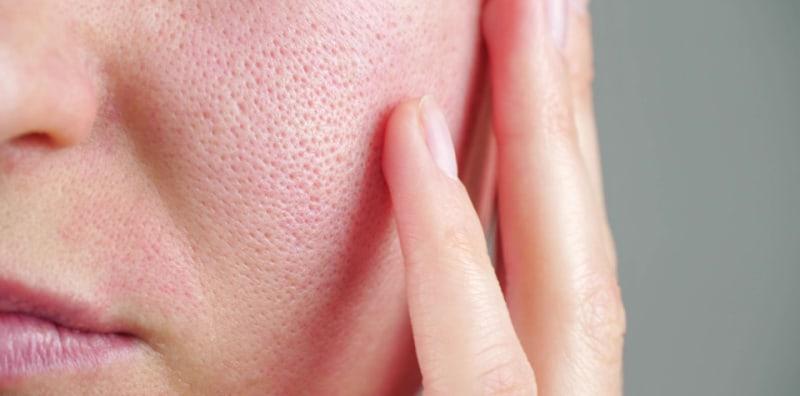 Kulit Wajah Bermasalah Kerana Liang Pori Besar? Ini 12 Cara Nak Kecilkan Pori